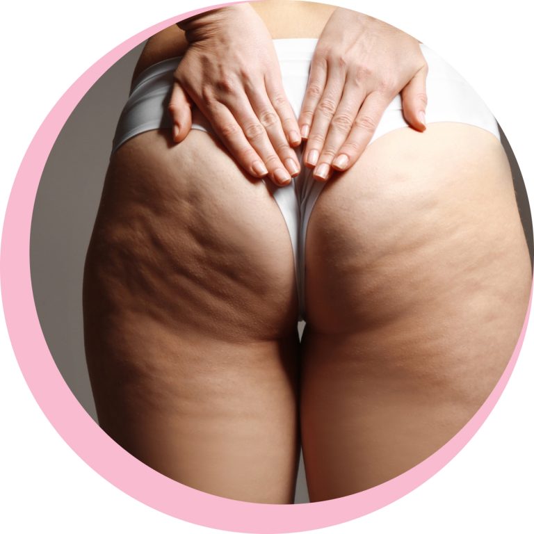 cellulite blocco1